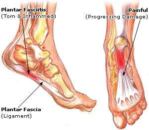 During the exam, your doctor will check for areas of tenderness in your foot. Zisu's Daily: Plantar Fasciitis Product Review