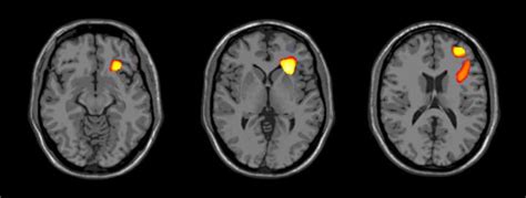 Adolescent Brain Develops Differently In Bipolar Disorder