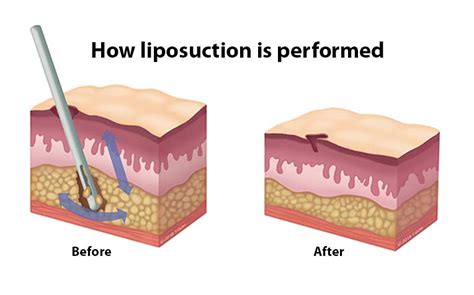 Liposuction What You Need To Know Healthxchange