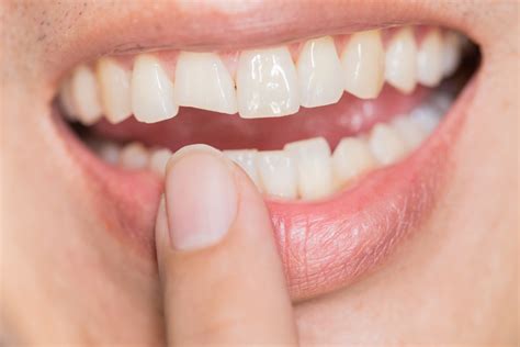 The 5 Best Cosmetic Dentistry Options To Repair A Chipped Tooth Nyccd