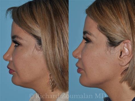Chin Liposuction Before And After Richard Zoumalan