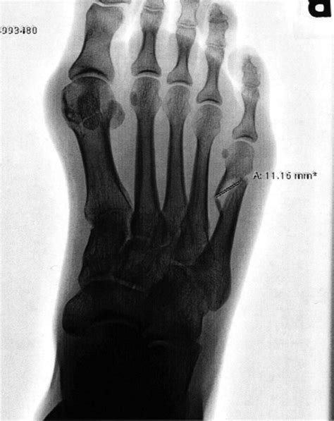 A New Radiographic Classification For Distal Shaft Fifth Metatarsal
