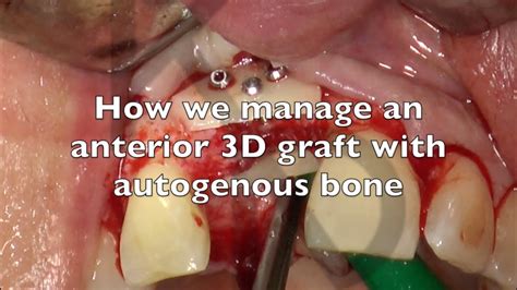 How We Manage An Anterior 3d Graft With Autogenous Bone Youtube