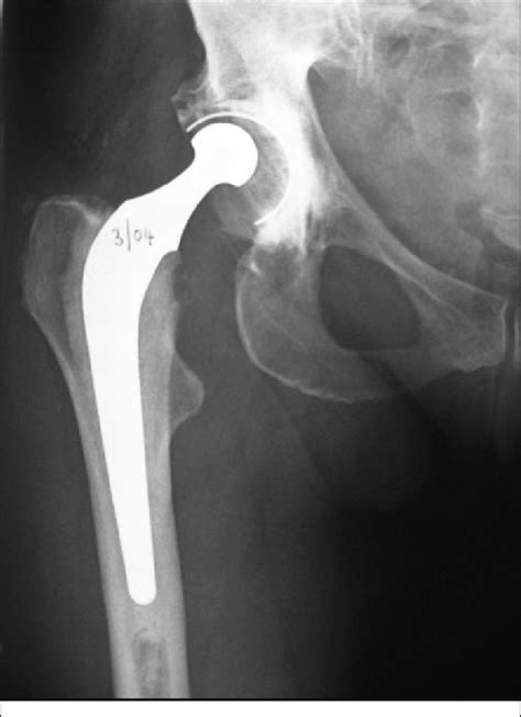 X Ray Of A Charnley Thr At 12 Years In Active Asymptomatic Patient