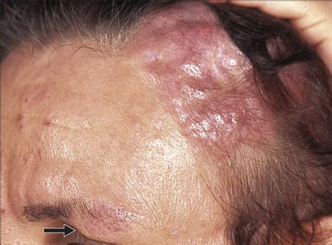 Anetodermic Primary Cutaneous B Cell Lymphoma A Unique