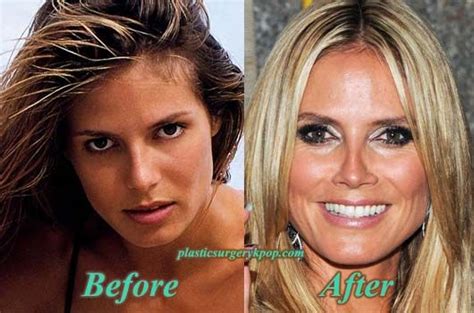 Heidi Klum Nose Job Before And After Plastic Surgery