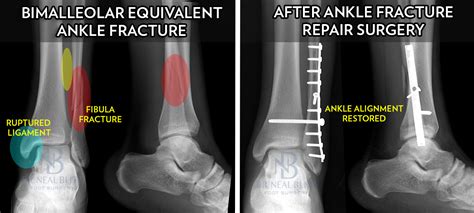 When To Fix A Broken Ankle Huffpost Life