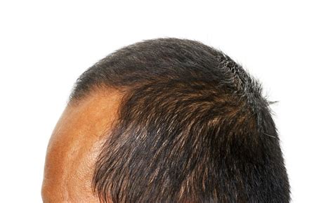 Widows Peak Treatment How To Get Rid Of A Thinning Hairline