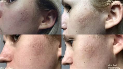 50% off on mesotherapy for face black friday offer mesotherapy in dubai. photos before and after - fractional co2 laser & platelet ...