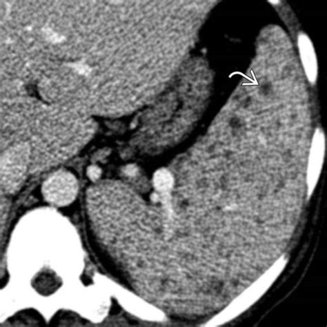 Splenic Infection And Abscess Clinical Gate
