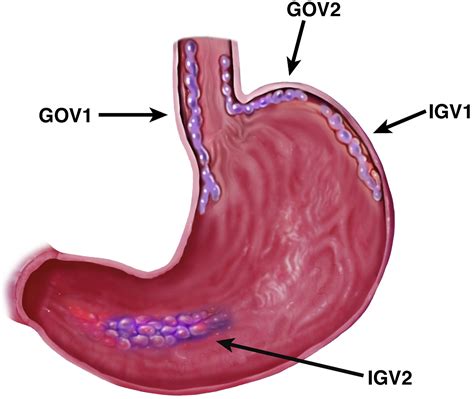 Management Of Gastric Varices Clinical Gastroenterology And Hepatology