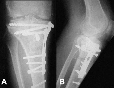 Complications After Tibia Plateau Fracture Surgery Injury