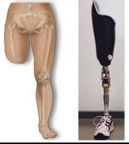 Above Knee Prosthesis At Rs 40000 New Items In Secunderabad Id