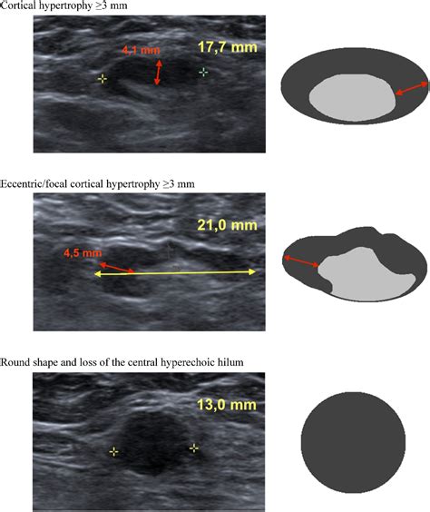 Diagnostic Accuracy Of Axillary Staging By Ultrasound In Early Breast