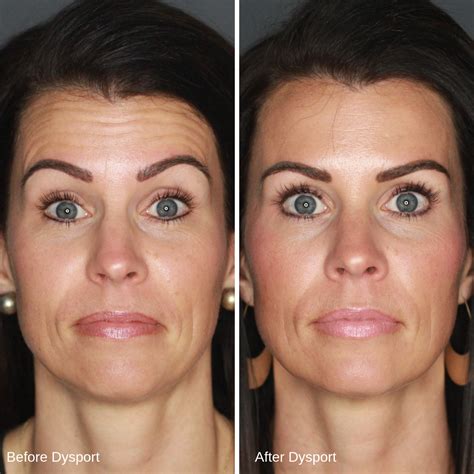 Botox Before And After 20 Units Before And After