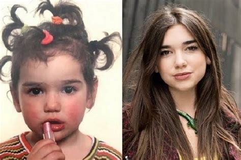 Dua Lipa Before And After Plastic Surgery Nose Lips Face