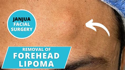 Excision Of Large Forehead Lipoma Dr Tanveer Janjua New Jersey