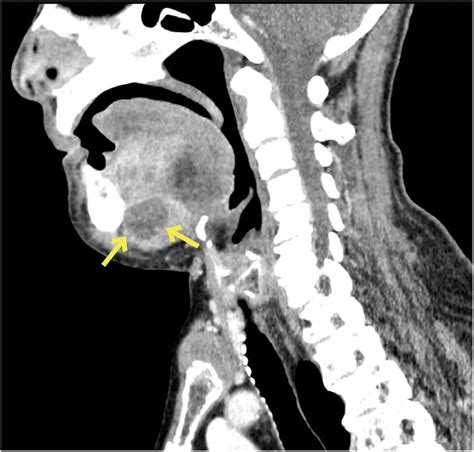 A Woman With Swelling Of The Neck Emergency Medicine Journal