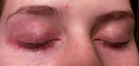 Dry Skin And Red Spots Around Eyelids Its Not Very Itchy And Its
