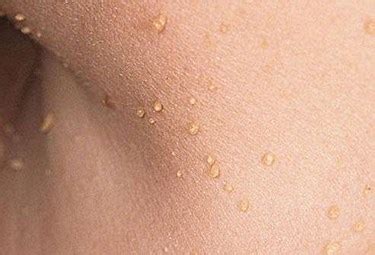 On penis, skin tags can be seen as fleshy outgrowths on the shaft and tip on the penis. Guide to Cutting Off Skin Tags Safely at Home - Skin Tags Gone