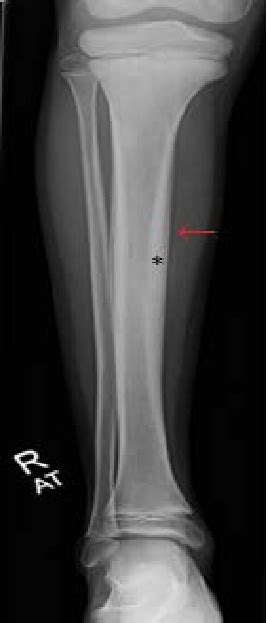 X Ray Of Tibia And Fibula Periosteal Elevation Is Denoted By The Arrow