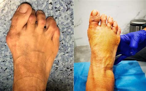 Tratamiento y Cirugía de los Dedos en Garra Doctor Iborra