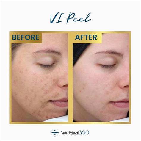 Vi Peel Before And After Feel Ideal Med Spa Southlake Tx