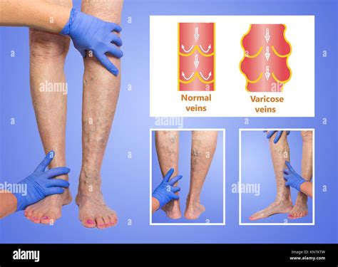 Varicose Veins On A Female Senior Legs The Structure Of Normal And Varicose Veins Collage