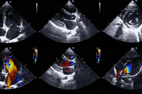 What To Expect During An Echocardiogram Upmc Healthbeat