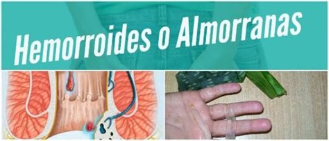 Almorranas O Hemorroides Causas Tipos Síntomas Prevención
