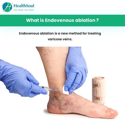 Endovenous Ablation Indications And Risks Healthsoul