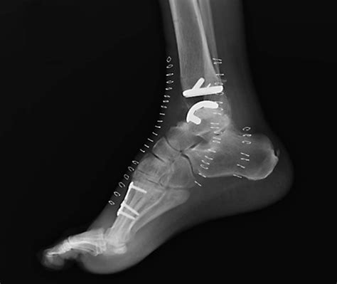 Total Ankle Replacement Becomes More Common As Treatment Improves The