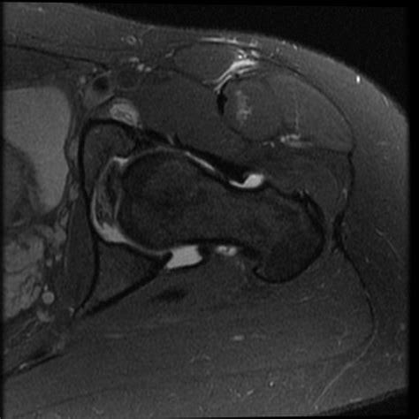 Paralabral Cyst Of The Hip Us And Mri Image