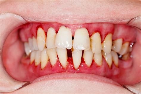 Gum Disease Treatment Florence Sc