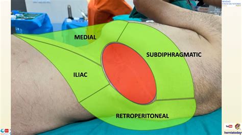 Stepwise Abdominal Wall Reconstruction Of A Thoracolumbar Hernia Youtube