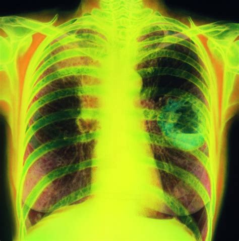 Coloured Chest X Ray Showing Lung Cancer Photograph By Simon Fraser