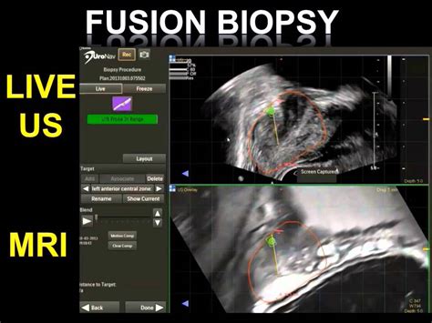 What Is A Mr Us Fusion Guided Prostate Biopsy Youtube