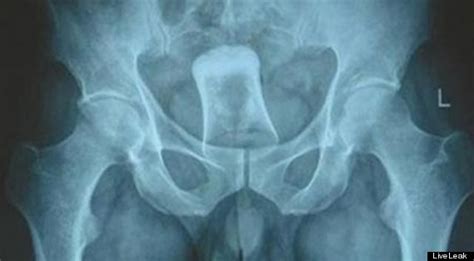 Shot Glass Inserted Into Anus Of Chinese Man Who Was Asked For