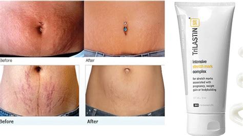Best Cream For Stretch Marks Removal Results Within Months Youtube