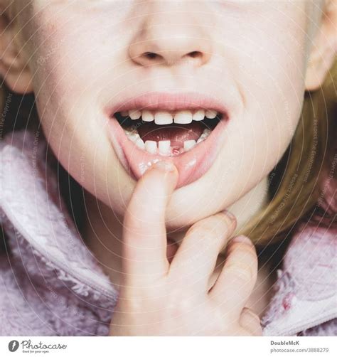Foto Mädchen zeigt Zahnlücke da sie den ersten Milchzahn verloren hat