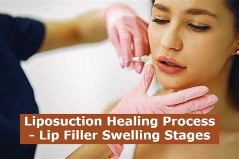 Liposuction Healing Process Lip Filler Swelling Stages