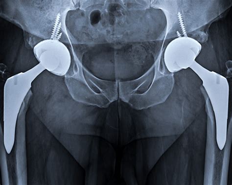 hip replacement adam sassoon m d m s