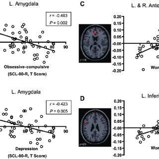 Progressive Grey Matter Gm Loss Correlated With The Severity Of