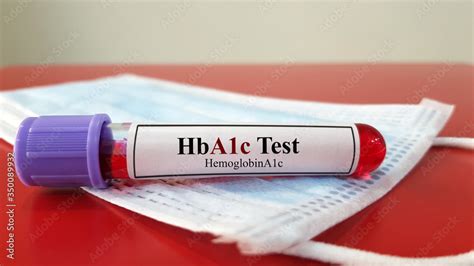 Laboratory Sample Tube Of Glycalated Hemoglobin Or Hemoglobin A1c Test