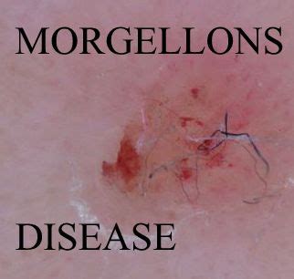 Morgellons is an unexplained and debilitating condition that has emerged as a public health concern. Joni Mitchell - The Truth Denied Alternative News
