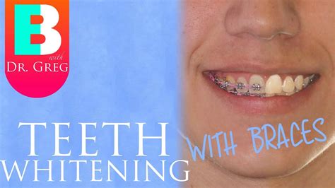 Teeth Whitening With Braces And Invisalign Youtube