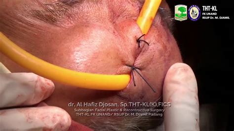 Paramedian Forehead Flap Tahap 1 YouTube