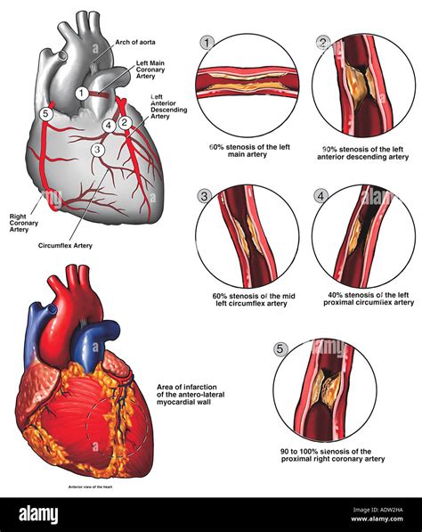 Enfermedad De La Arteria Coronaria Aterosclerótica Fotografía De Stock