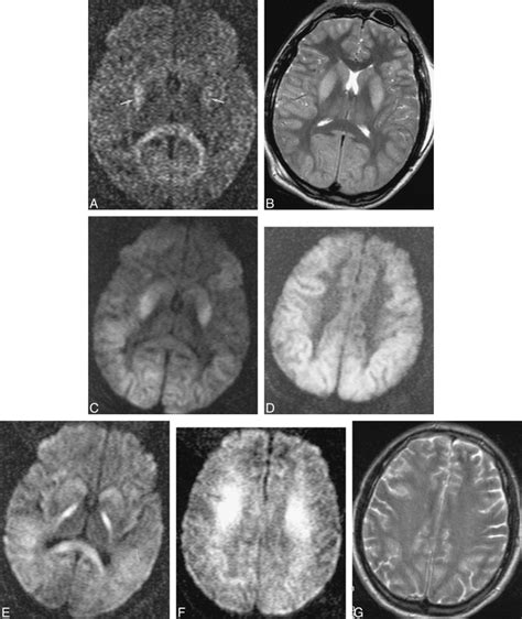 Diffusion Weighted Mr Imaging Ofglobal Cerebral Anoxia American