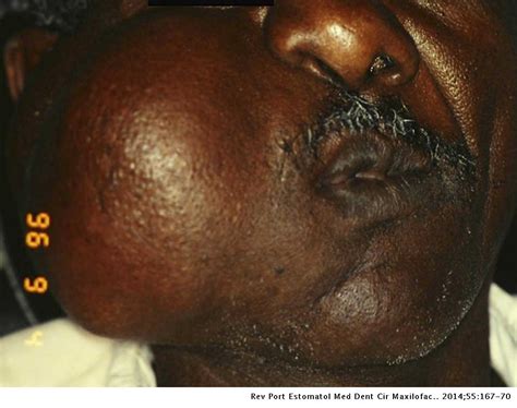Giant Facial Dermoid Cyst A Case Treated By Marsupialization Revista